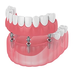 Digital illustration of dental implant dentures in Sunnyvale
