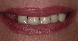 Dark colored teeth before