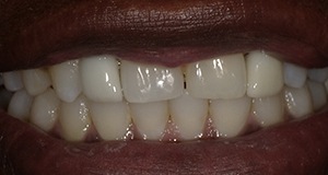 Tooth-colored crown on front tooth after