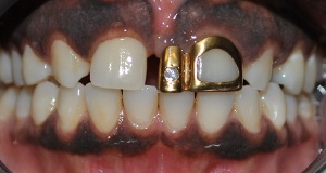 Dark colored crown on front tooth before