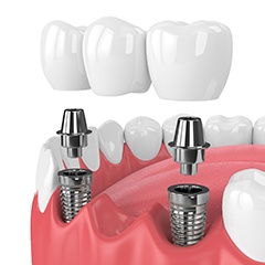 dental bridge being placed onto two dental implants
