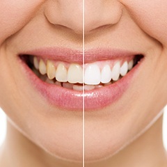 Before and after teeth whitening image