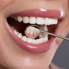 Closeup of dental mirror reflecting backs of woman’s lower teeth