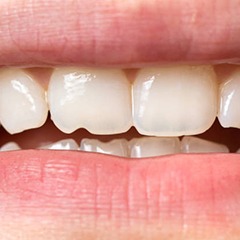 Patient with a chipped front tooth