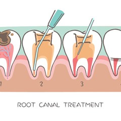 illustration for root canal therapy in Sunnyvale