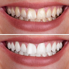 before-and-after image of a person’s smile who got teeth whitening
