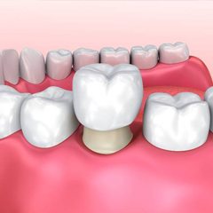 Model of dental crown