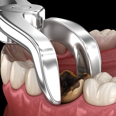 computer illustration showing a tooth extraction in Sunnyvale