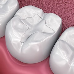 tooth-colored filling on bottom molar 