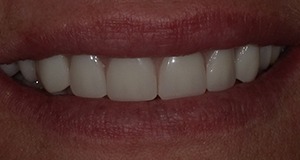 Bright white smile after