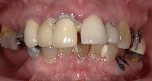 Unhelathy damaged smile before