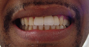 Closeup of smile with replaced teeth after
