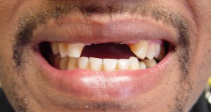 Closeup of smile with missing teeth before