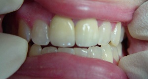 Repaired front tooth after