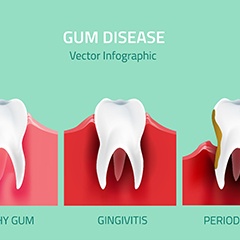 Illustration of the various stages of gum disease