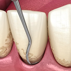 3D image of tooth cleaning