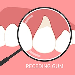 Illustration of receding gums