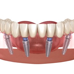 Diagram of a dental model holding dental implants in Sunnyvale
