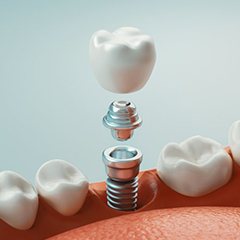 dental implant in Sunnyvale being placed in the mouth
