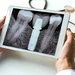 dentist holding a tablet showing an X-ray of a dental implant patient