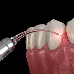 Illustration of dental laser being used for gum disease treatment