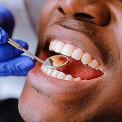 Closeup of smile during dental exam