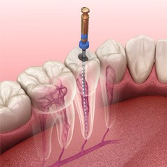 A 3D illustration of the root canal process