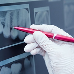 Pen pointing to root canal on x-rays