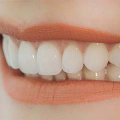 Woman with veneers in Sunnyvale smiling