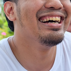 A man showing his stained smile