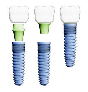 Image of dental implants