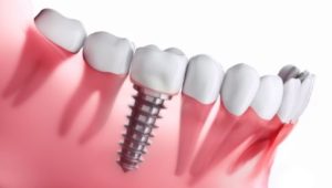 Model of an implant in a lower jaw