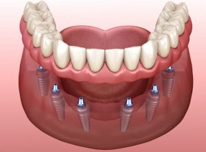 diagram of implant dentures