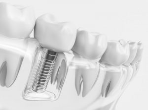 dental implant in Sunnyvale