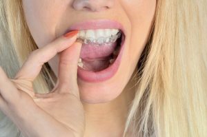 blonde woman taking out Invisalign in Sunnyvale