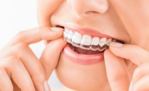 Person wearing their Invisalign aligner.