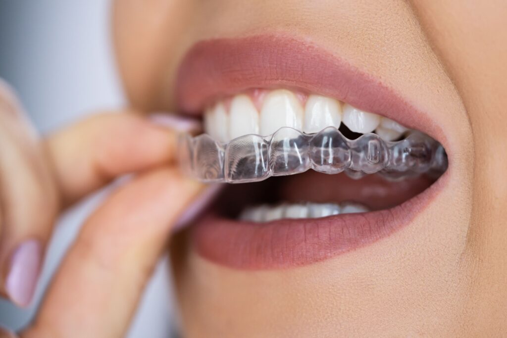 Closeup of woman placing clear aligners over upper arch of teeth