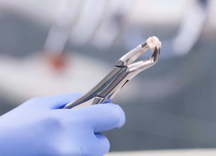 Tooth on forceps